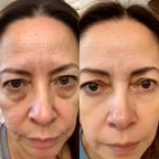 MENOLAE RESTORE® Dual-Wavelength Red Light Therapy For Perimenopausal Skin